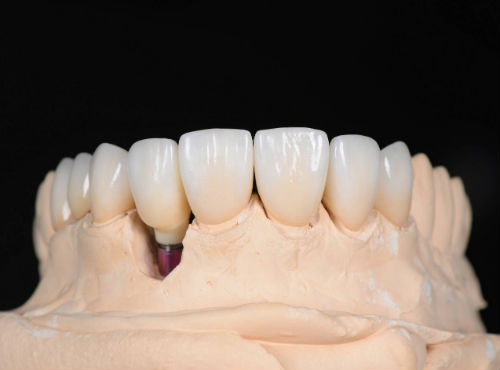 Протезы нижних зубов