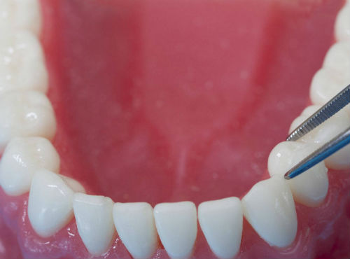Протезирование нижних зубов