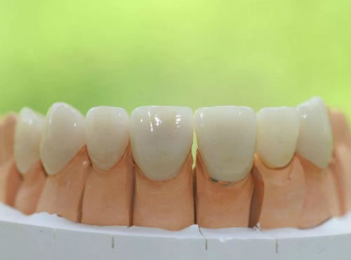 Протезы передних зубов