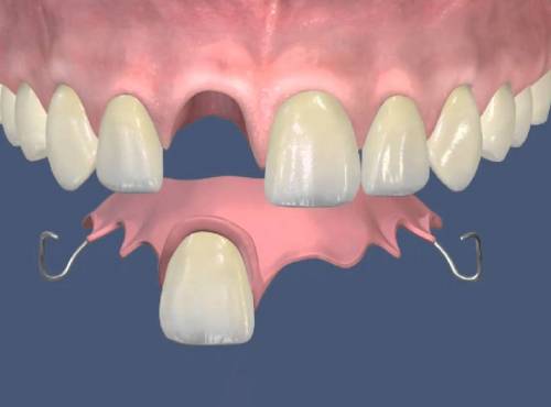 Варианты восстановления зуба без корня