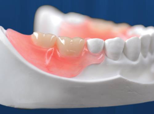 Съемный протез на 4 зуба