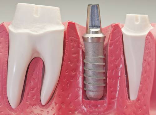 Установка имплантанта зуба