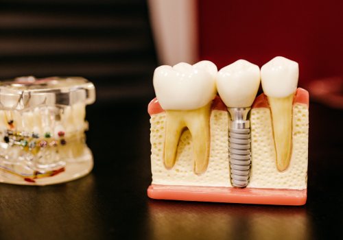Сколько стоит имплант зуба под ключ