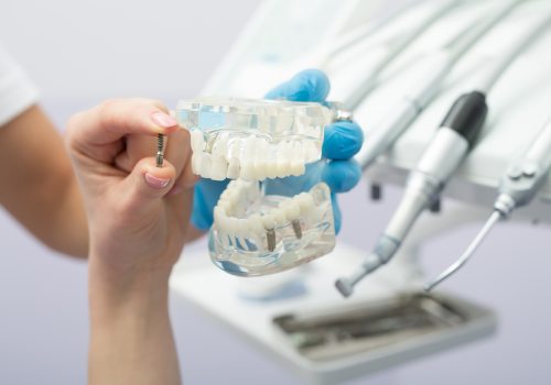 Стоимость имплантации зубов