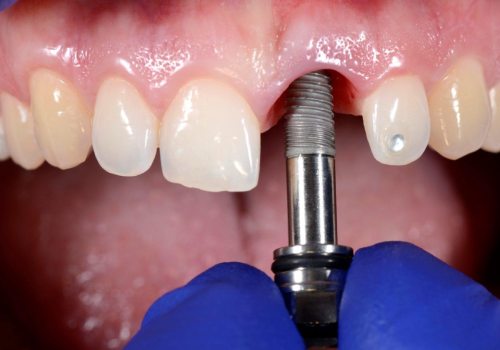 Сколько заживает зуб после имплантации