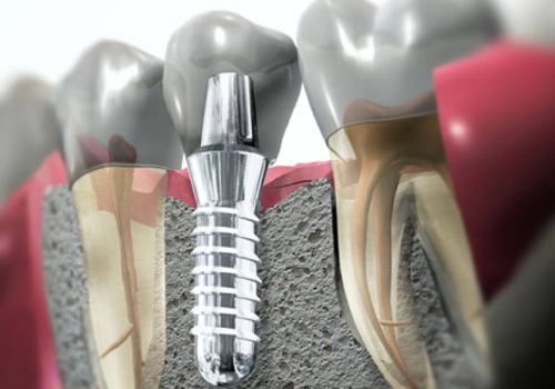 Срок службы имплантов зубов