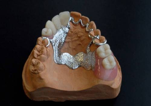 Бюгельные протезы зубов