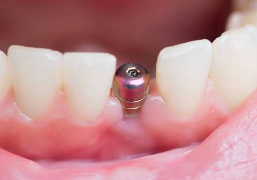 Удаление импланта зуба