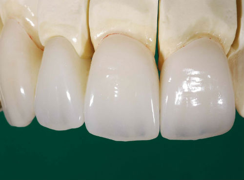 Временные протезы на зубы из пластмассы