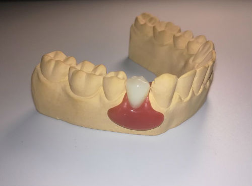 Временный протез на 1 зуб