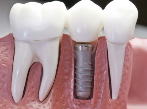 Временный зубной протез на 1 зуб