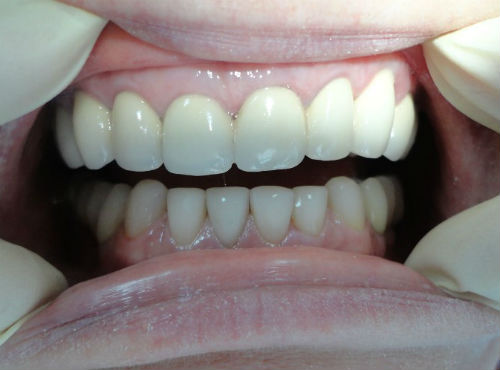 Временные протезы на передние зубы